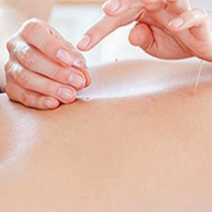 Acupuncture